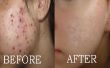 Cómo borrar marcas de acné | Las cicatrices oscuras | Manchas de espinillas, tener la piel limpia de cara