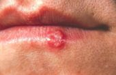 Deshacerse de herpes labial más rápido y prevenir la propagación. 