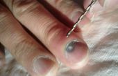 ¿Cómo drenar el Hematoma subungueal (pocket de sangre bajo la uña del dedo) con una broca de