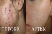 Cómo borrar marcas de acné | Las cicatrices oscuras | Manchas de espinillas, tener la piel limpia de cara
