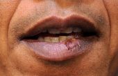 Cómo para conseguir deshacerse de herpes labial en la boca