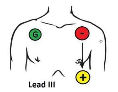 como+colocar+los+electrodos+en+ecg